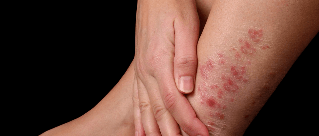 Псориазисни плаки по кожата на крака