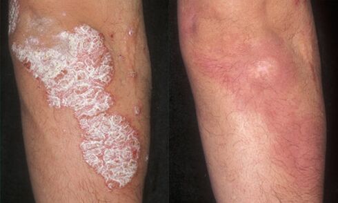 снимки преди и след лечение на псориазис