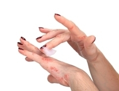 псориазис на ръцете