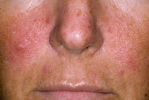 симптомите на псориазис на лицето