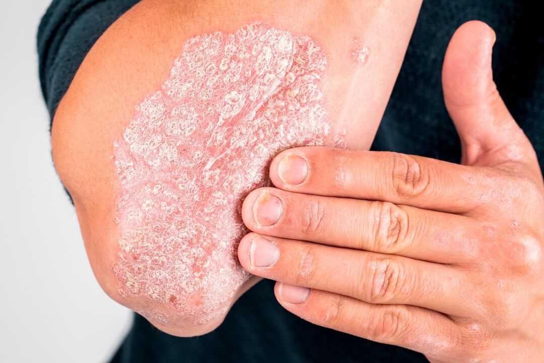 как изглежда псориазисът върху кожата
