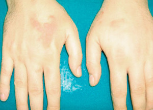 Локализация на болестта на ръцете