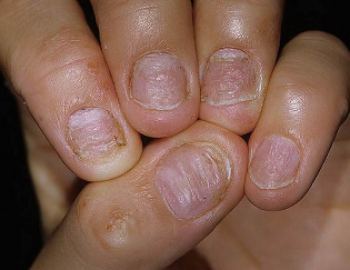 псориазис-на ноктите